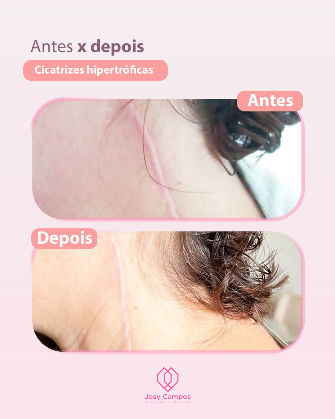 Antes x Depois_CICATRIZES HIPERTOFÓLICAS SITE-JOSYCAMPOS FISIOTERAPEUTA  DERMATOFUNCIONAL - SÃO JOSÉ DOS CAMPOS E VALE DO PARAIBA