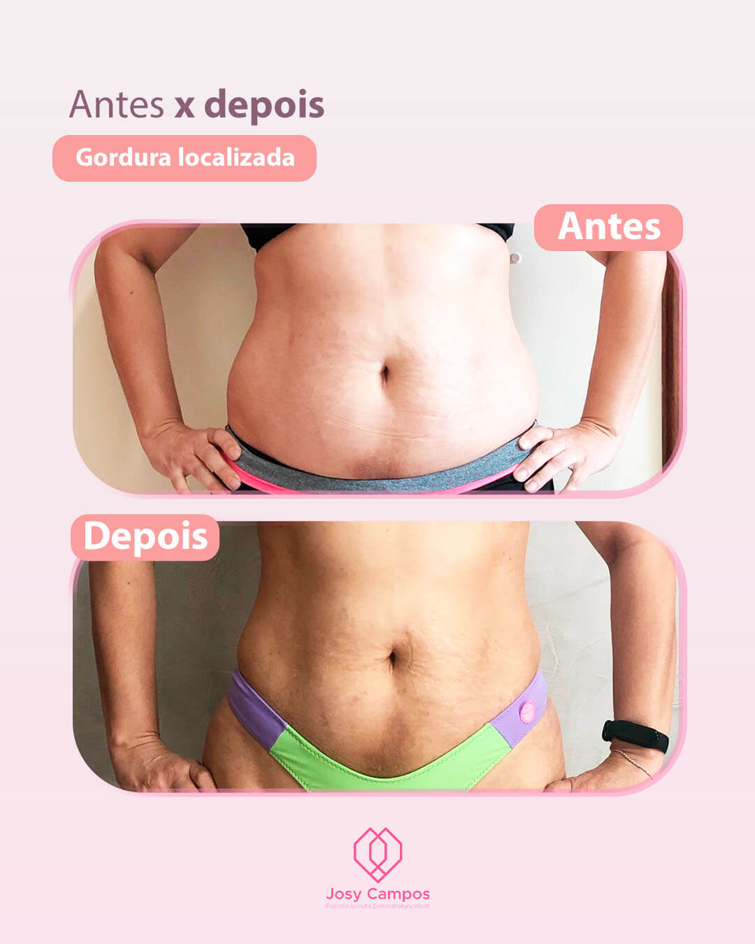 Antes x Depois_Gordura localizada SITE-JOSYCAMPOS FISIOTERAPEUTA  DERMATOFUNCIONAL - SÃO JOSÉ DOS CAMPOS E VALE DO PARAIBA