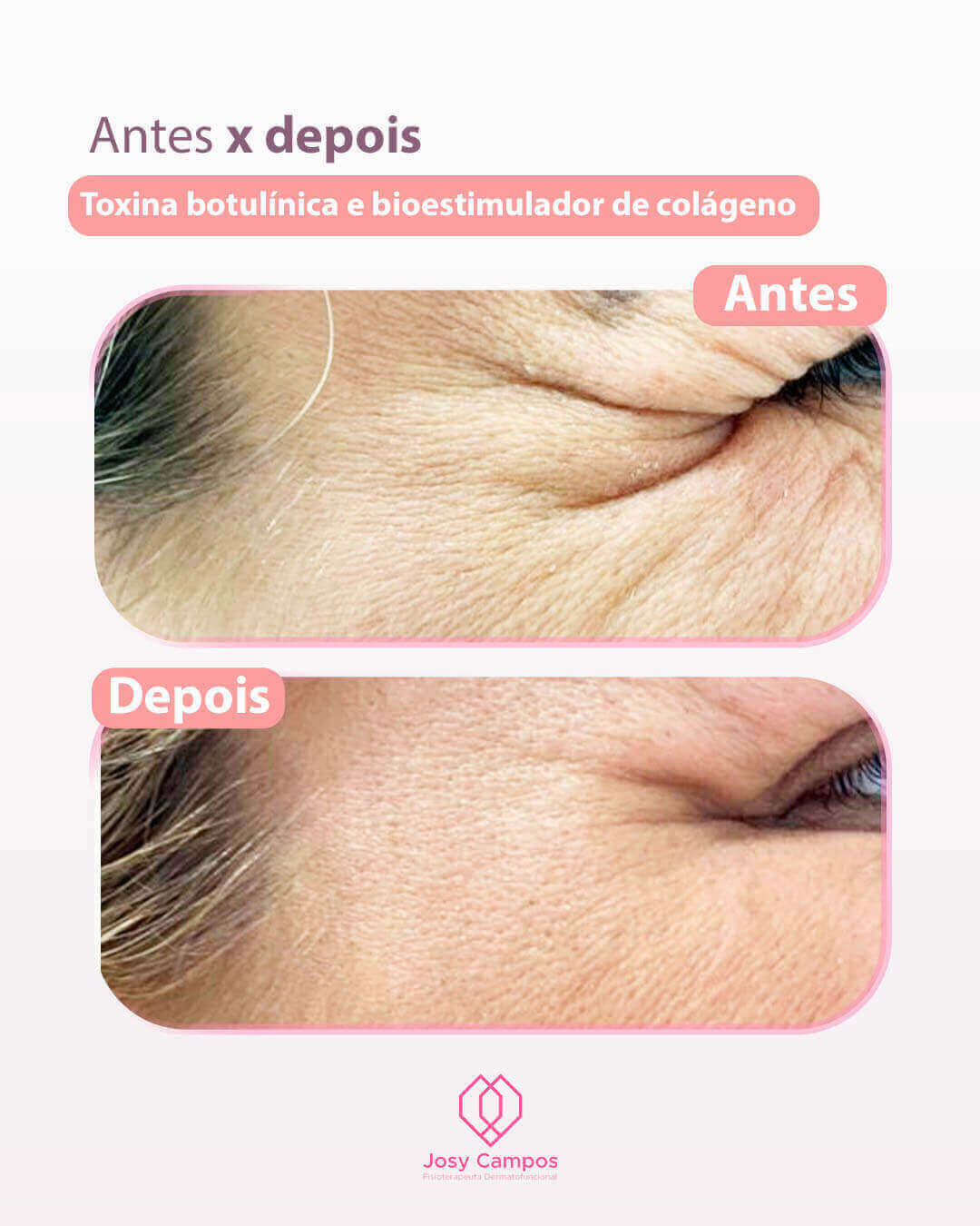 Antes x Depois_botulinica SITE-JOSYCAMPOS FISIOTERAPEUTA  DERMATOFUNCIONAL - SÃO JOSÉ DOS CAMPOS E VALE DO PARAIBA