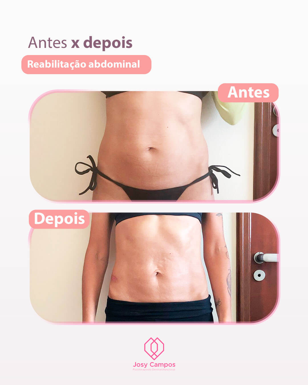 Antes x Depois_reabilitação abdominal SITE-JOSYCAMPOS FISIOTERAPEUTA  DERMATOFUNCIONAL - SÃO JOSÉ DOS CAMPOS E VALE DO PARAIBA