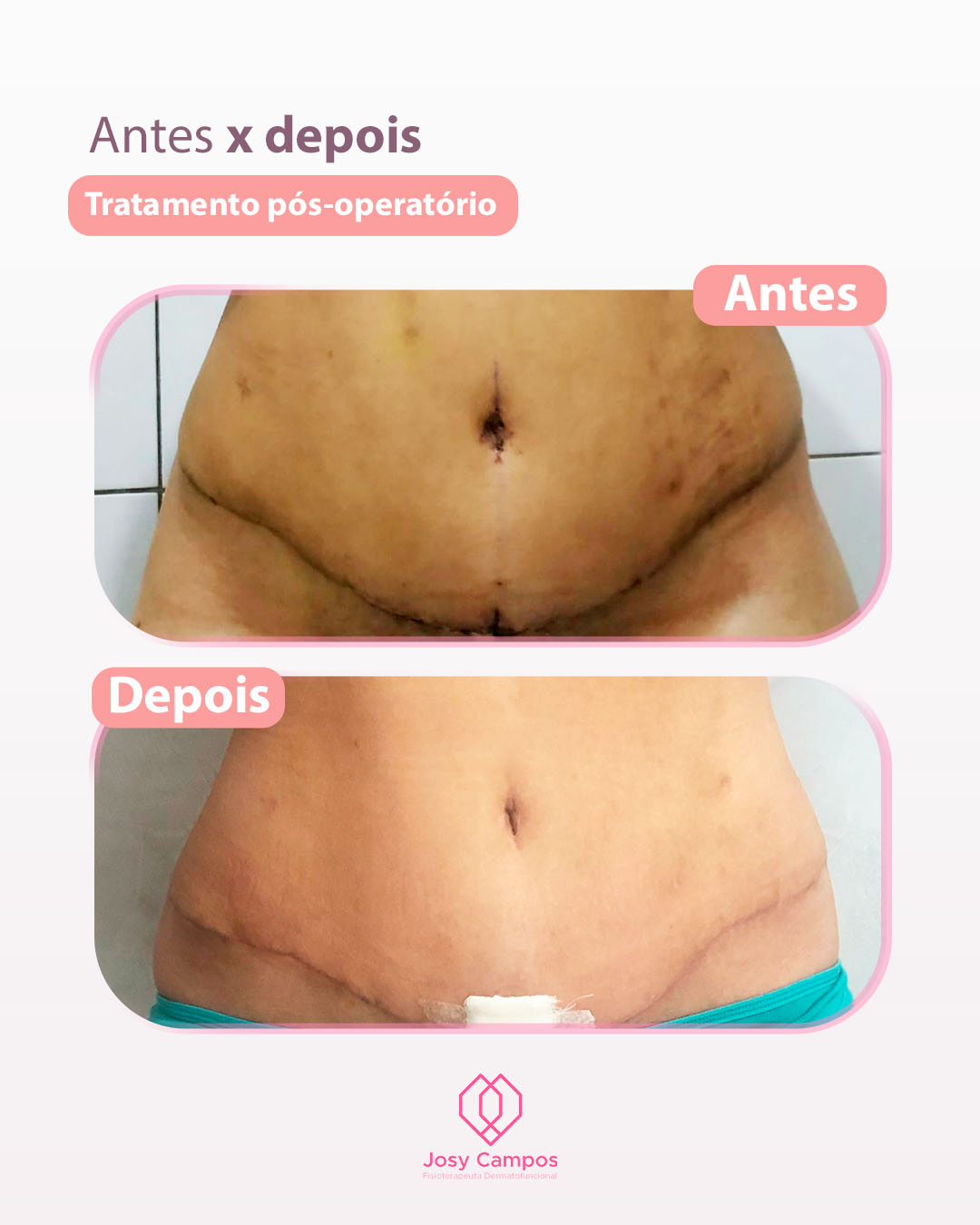 Antes x Depois_tratamento pós operatório SITE-JOSY CAMPOS FISIOTERAPEUTA  DERMATOFUNCIONAL - SÃO JOSÉ DOS CAMPOS E VALE DO PARAIBA