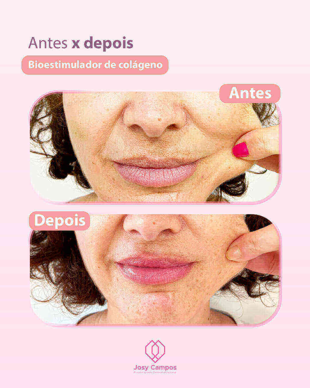 Antes x Depois_DEPOIS - BIOESTIMULADOR DE COLAGENO